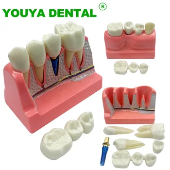 Зубной имплантат, Модель зубов, 4-кратный Анализ имплантата, Коронка, Мостовидный протез, Съемная модель, Демонстрационные инструменты для стоматологии, Обучение стоматолога