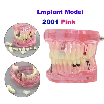 Стоматологическая модель зубов обучающая модель имплантата, заболевание, ремонт зубов, реставрационный мостовидный протез для стоматолога, обучающая демонстрация M2001, розовый.